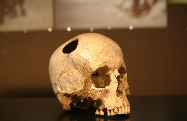 Trepaning